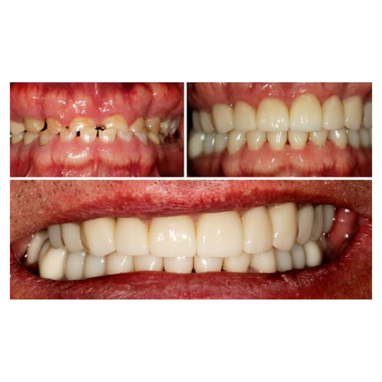 Full Mouth Rehabilitation