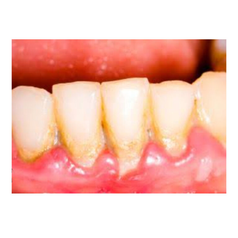 Gums treatment