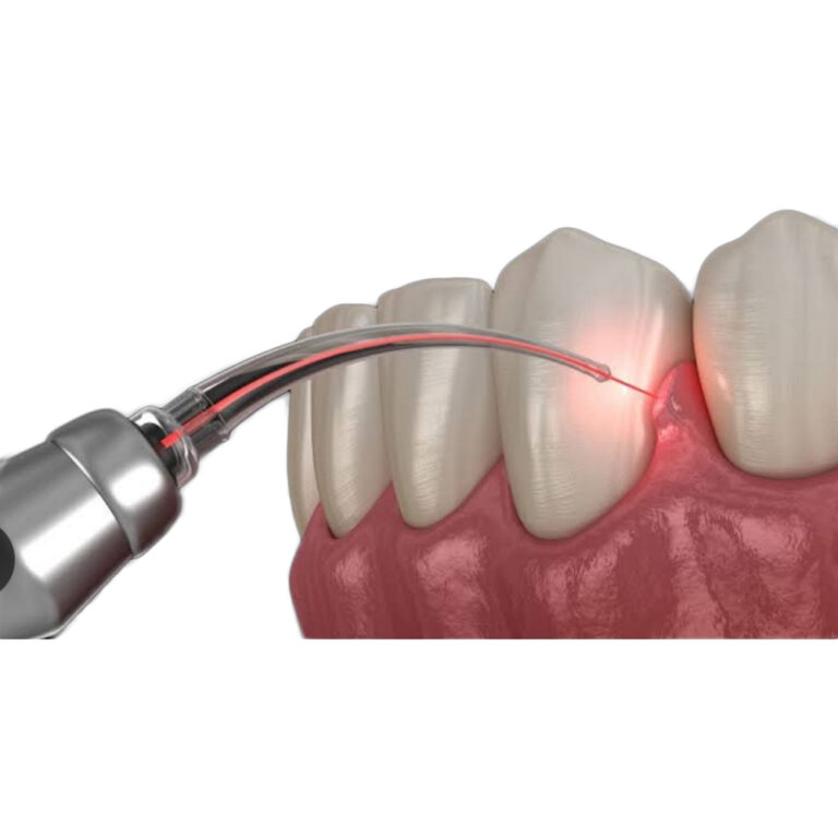 Laser dentistry