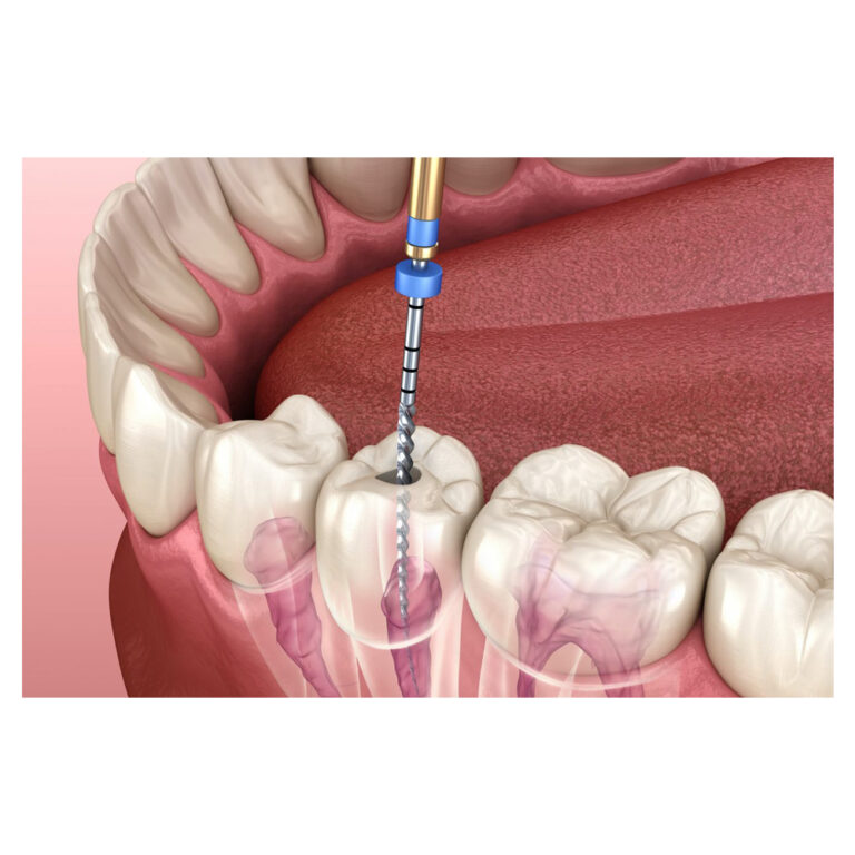 Root Canal Treatment