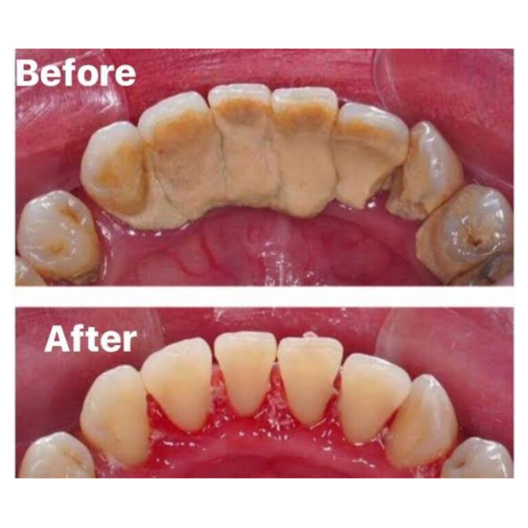 Scaling and Polishing