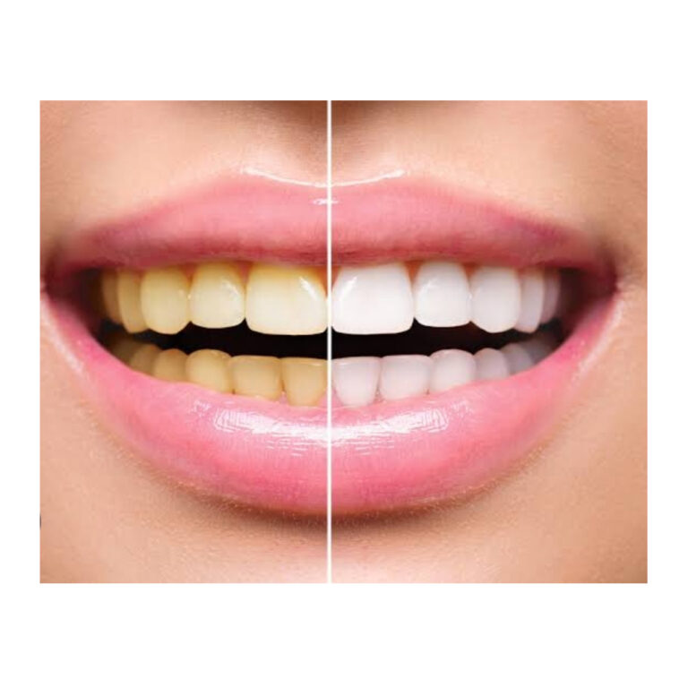 Teeth whitening