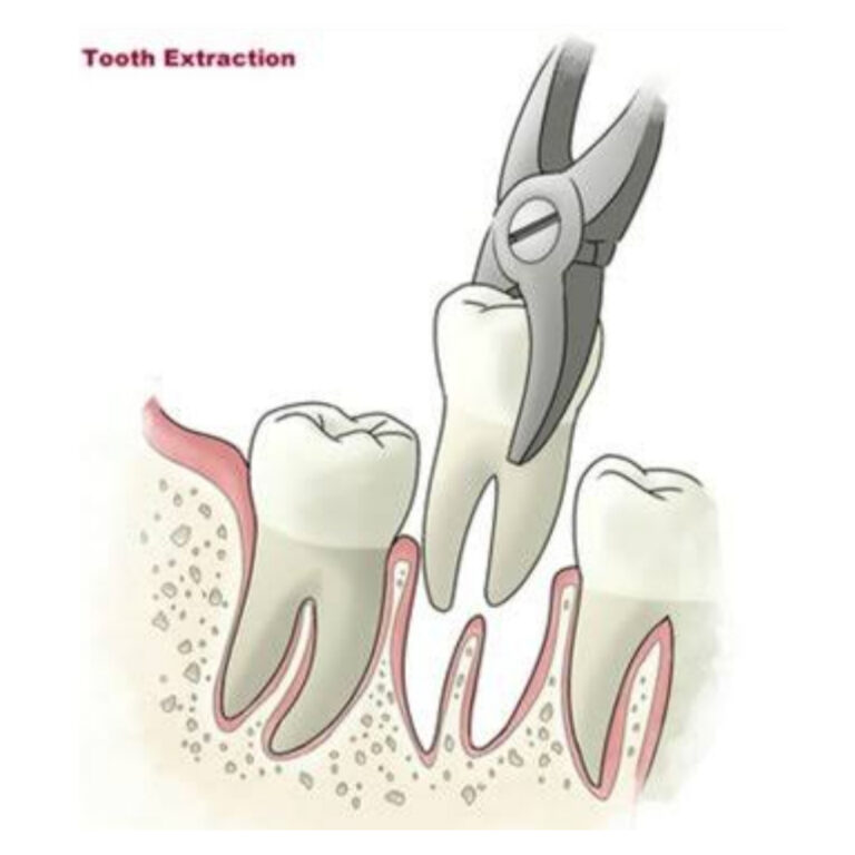 Tooth extraction