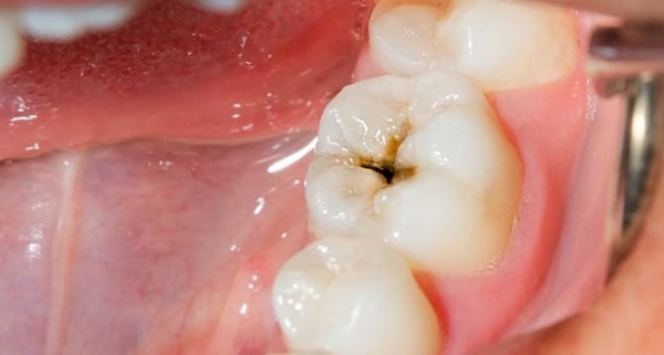 Tooth_decay_and_Cavities