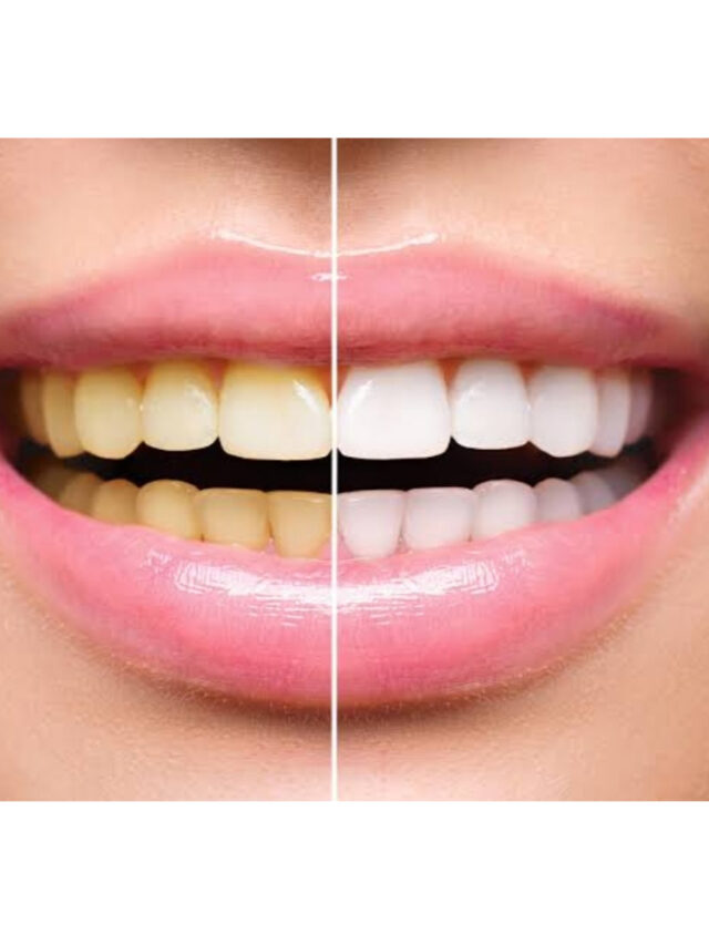 Teeth Whitening near me